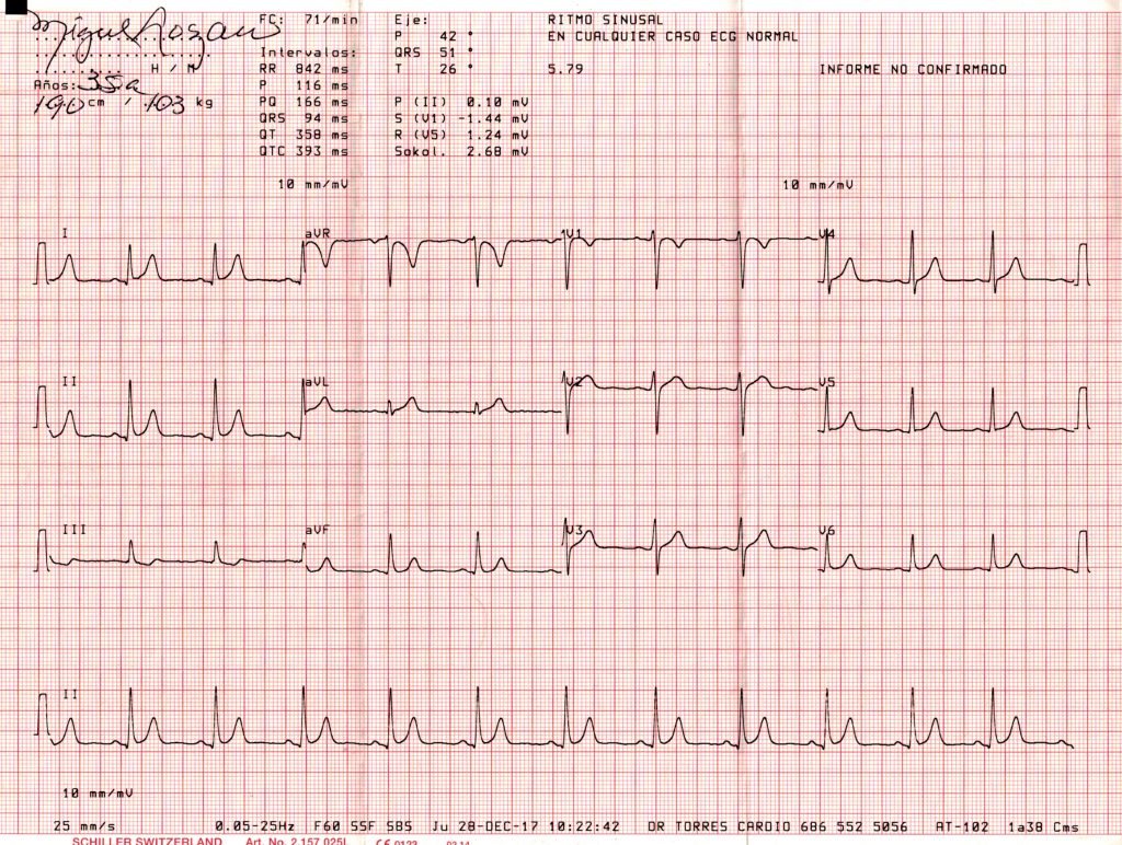 Electrocardiograma