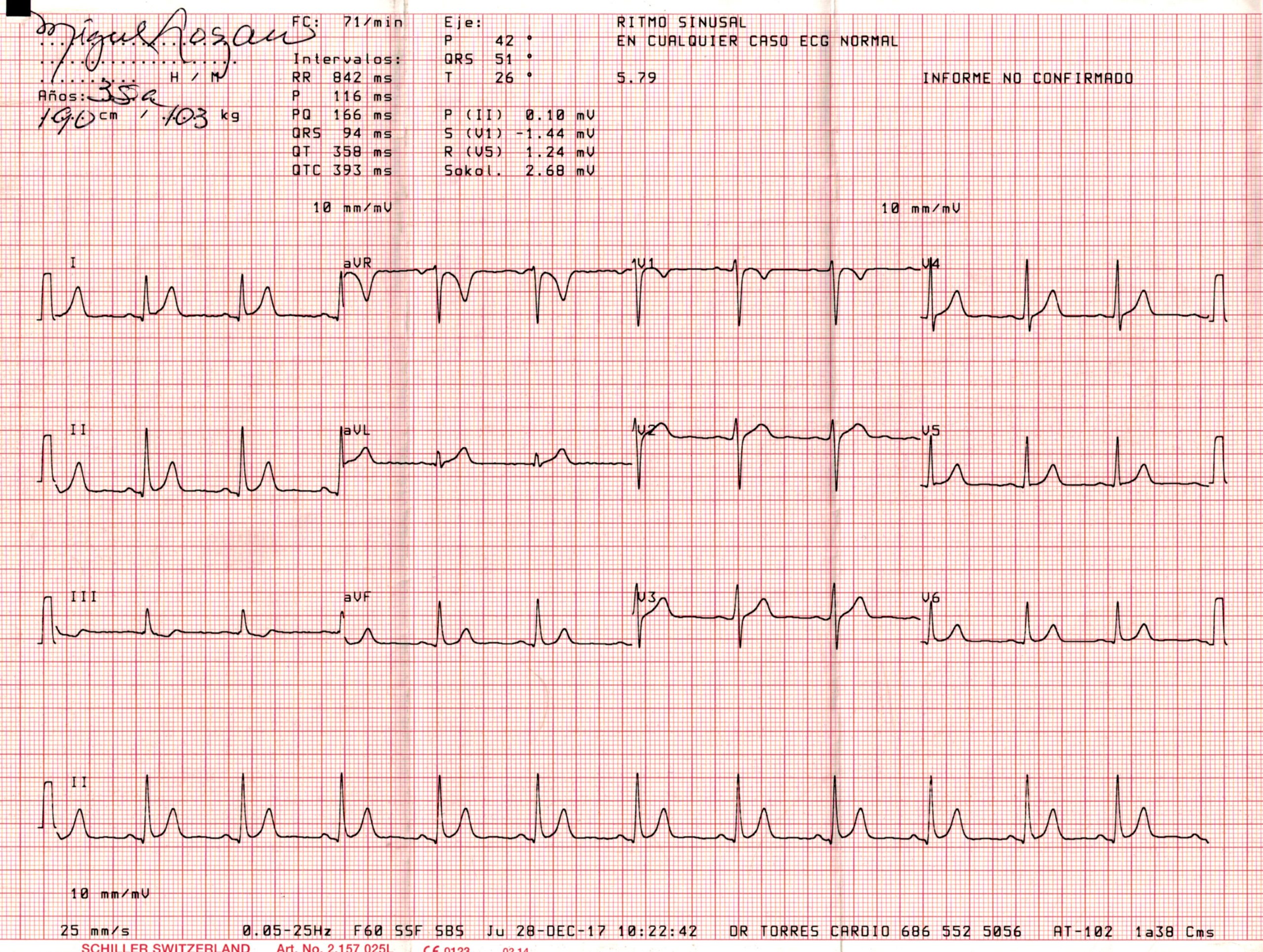 Electrocardiograma